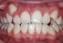 braces-3-before-2.jpg
