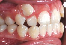 braces-3-before-3.jpg