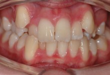 braces-before-2.jpg