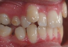 braces-before-3.jpg