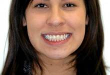 clear-braces-2-after-1.jpg