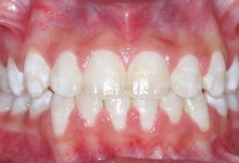 clear-braces-2-after-2.jpg