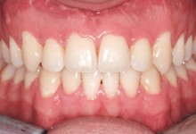 clear-braces-after-3.jpg